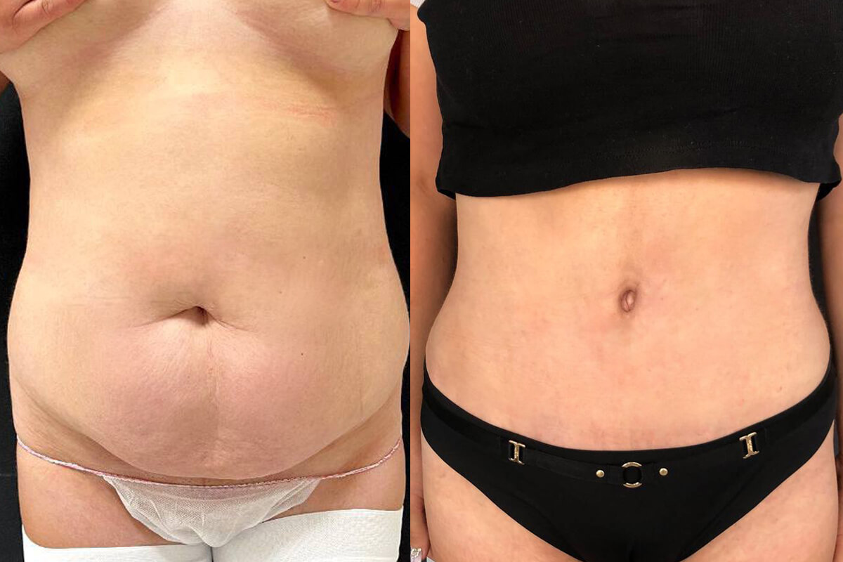 Ушивание диастаза 01