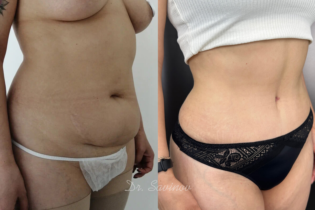 Ушивание диастаза 01