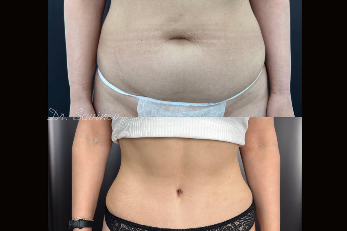 Ушивание диастаза 01