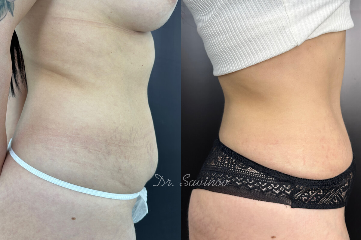 Ушивание диастаза 01