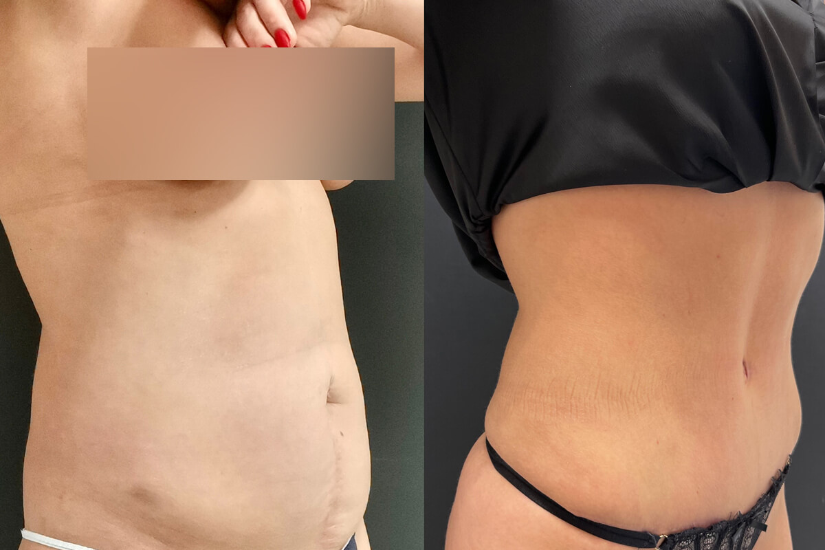 Ушивание диастаза 01