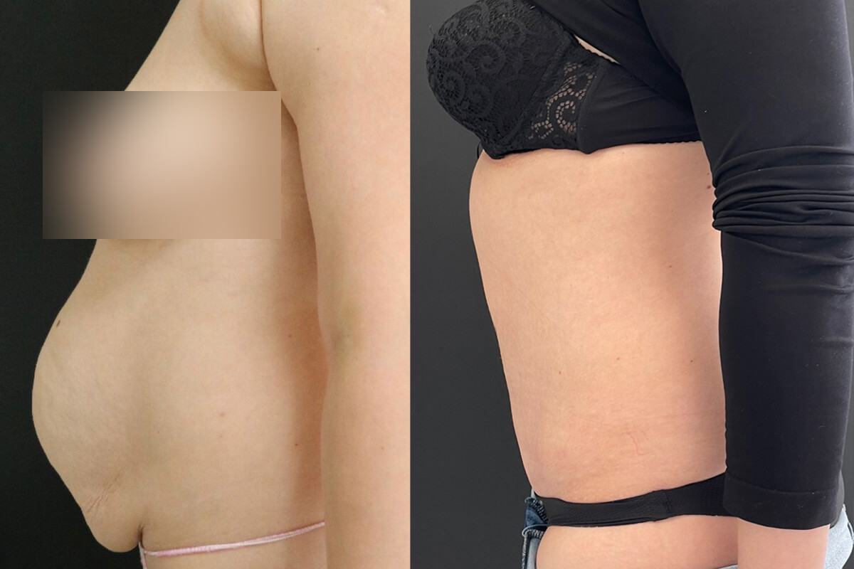 Ушивание диастаза 01