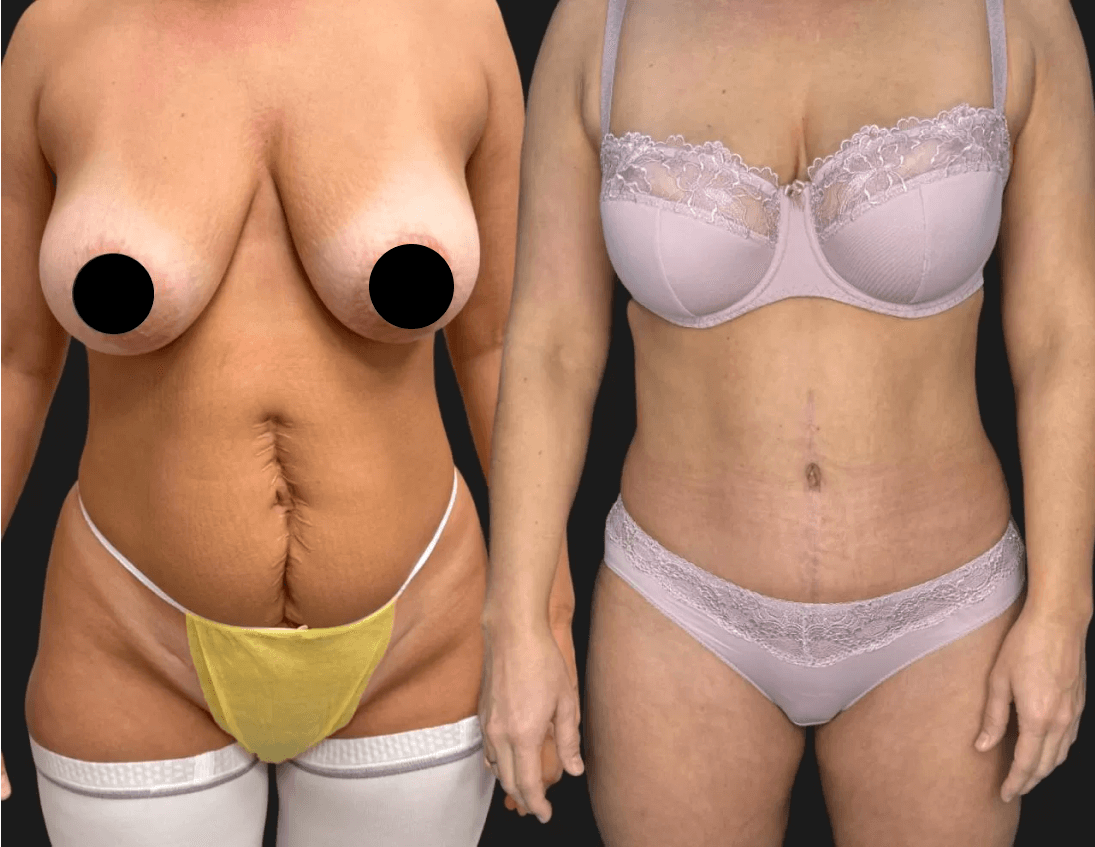 Абдоминопластика с переносом пупка 01