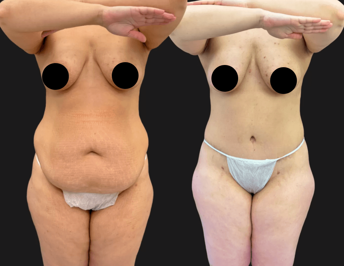 Абдоминопластика с переносом пупка 01