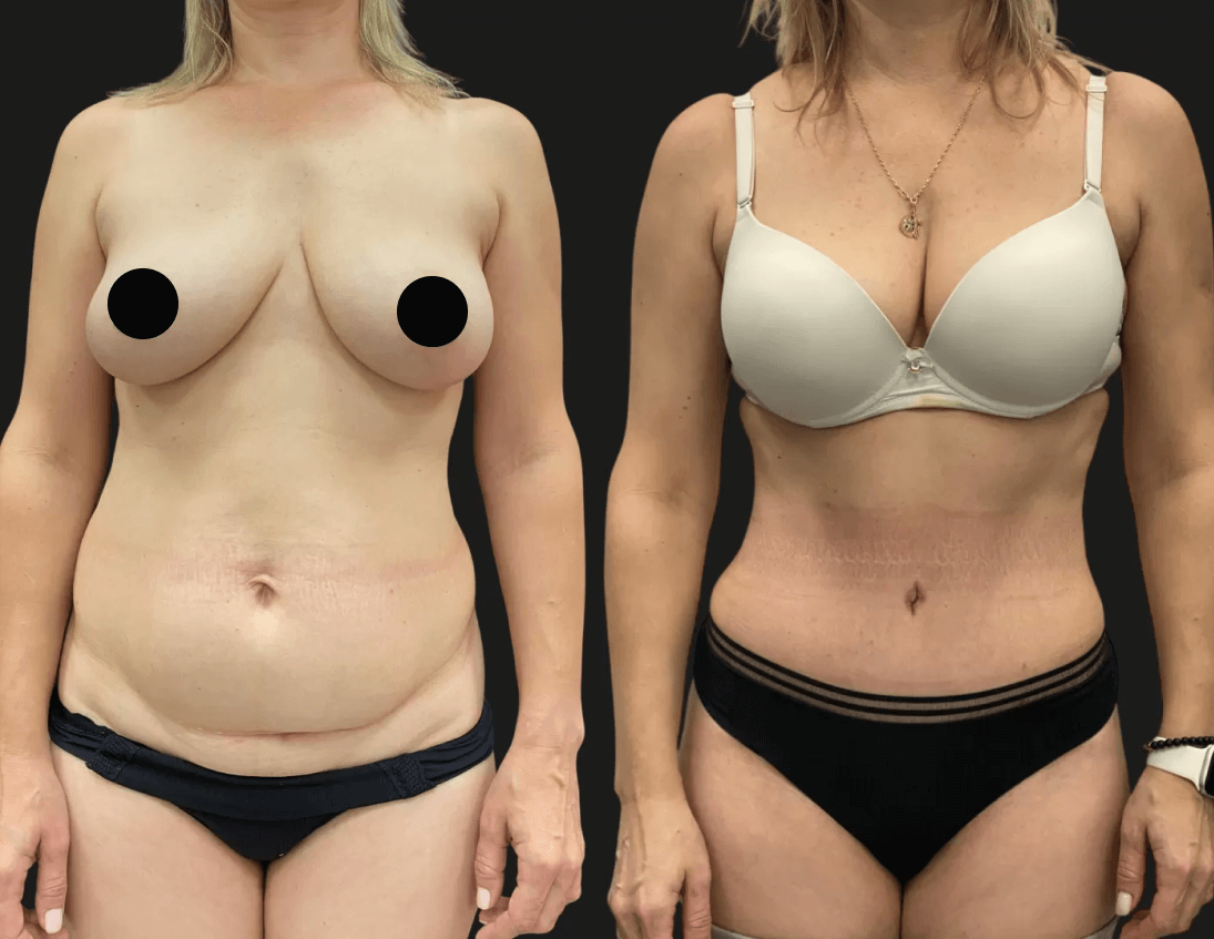 Абдоминопластика с липосакцией 01