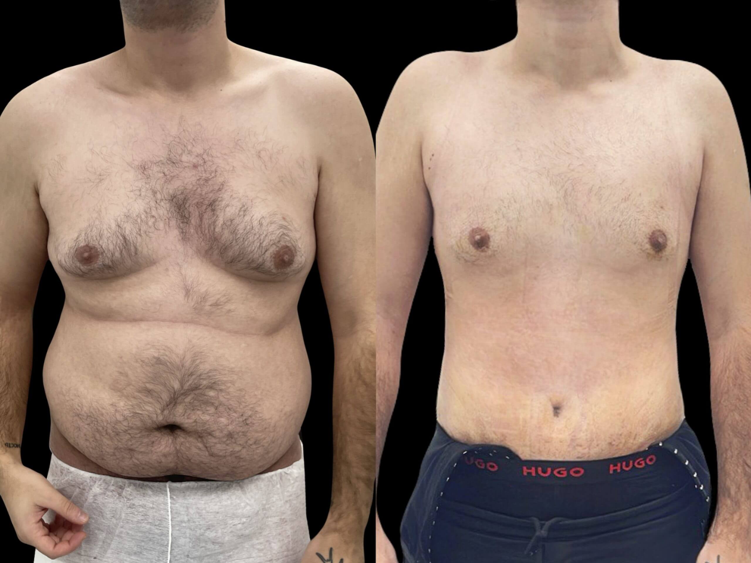 Абдоминопластика с переносом пупка 01