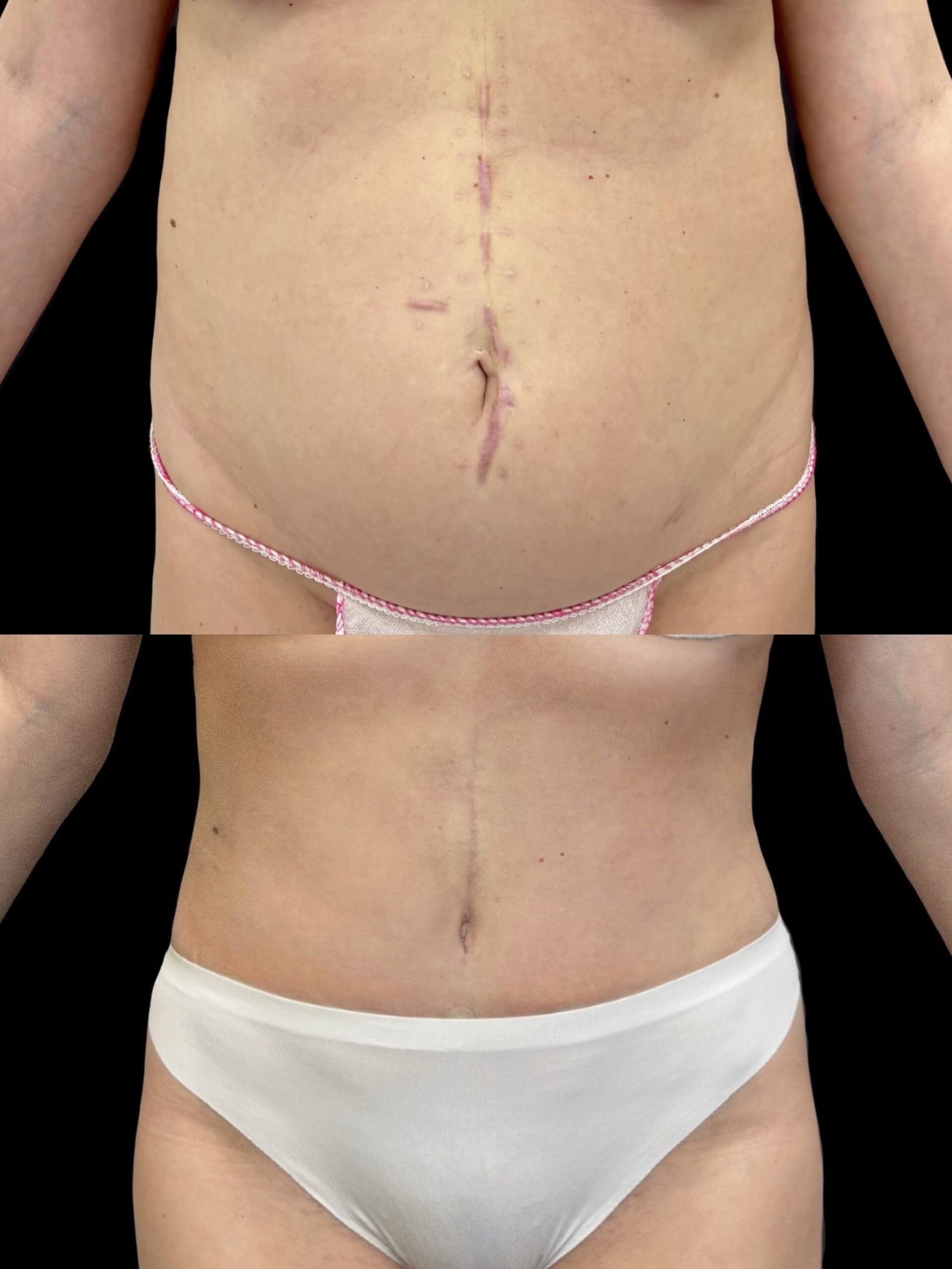Абдоминопластика с липосакцией 01