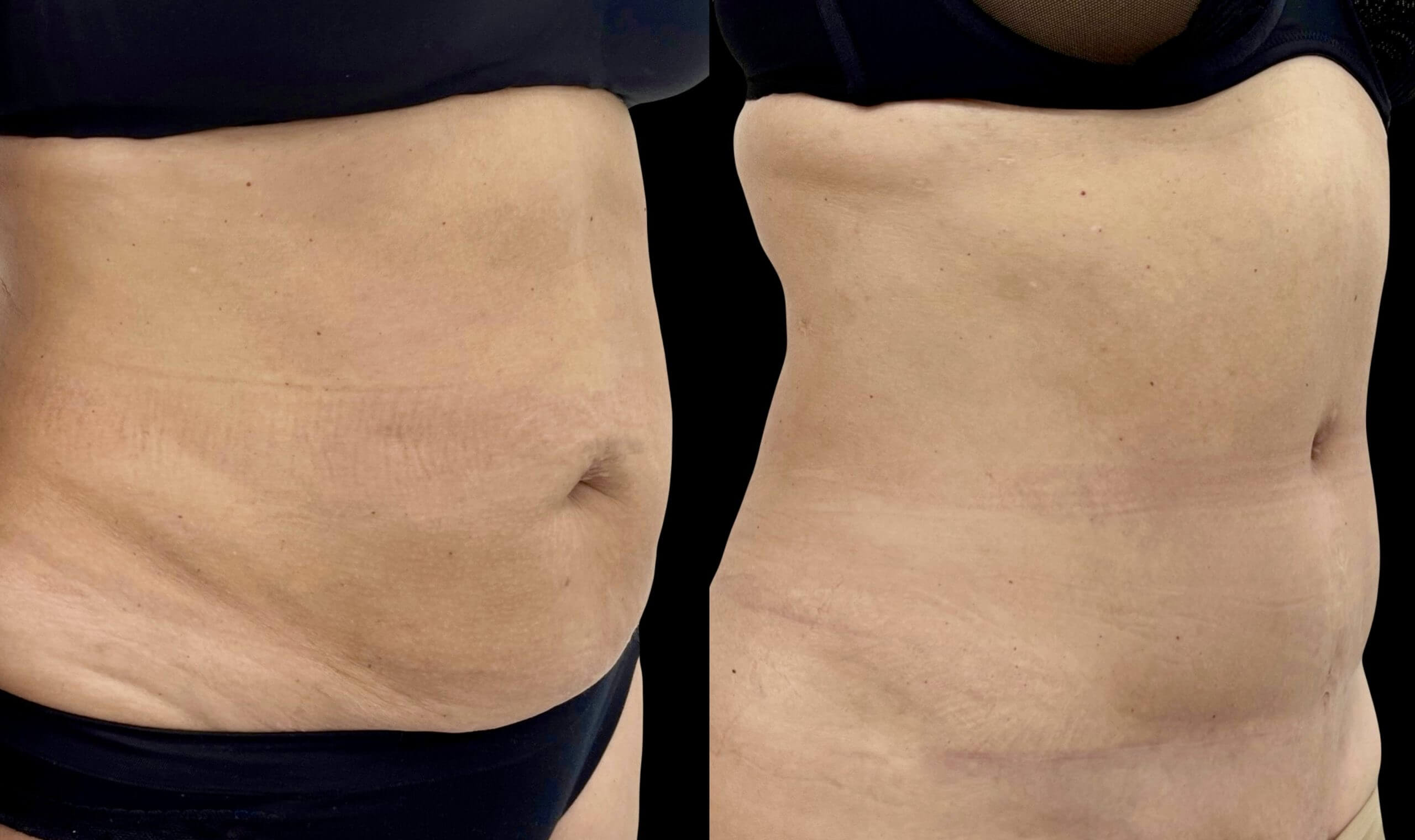 Абдоминопластика с липосакцией 01
