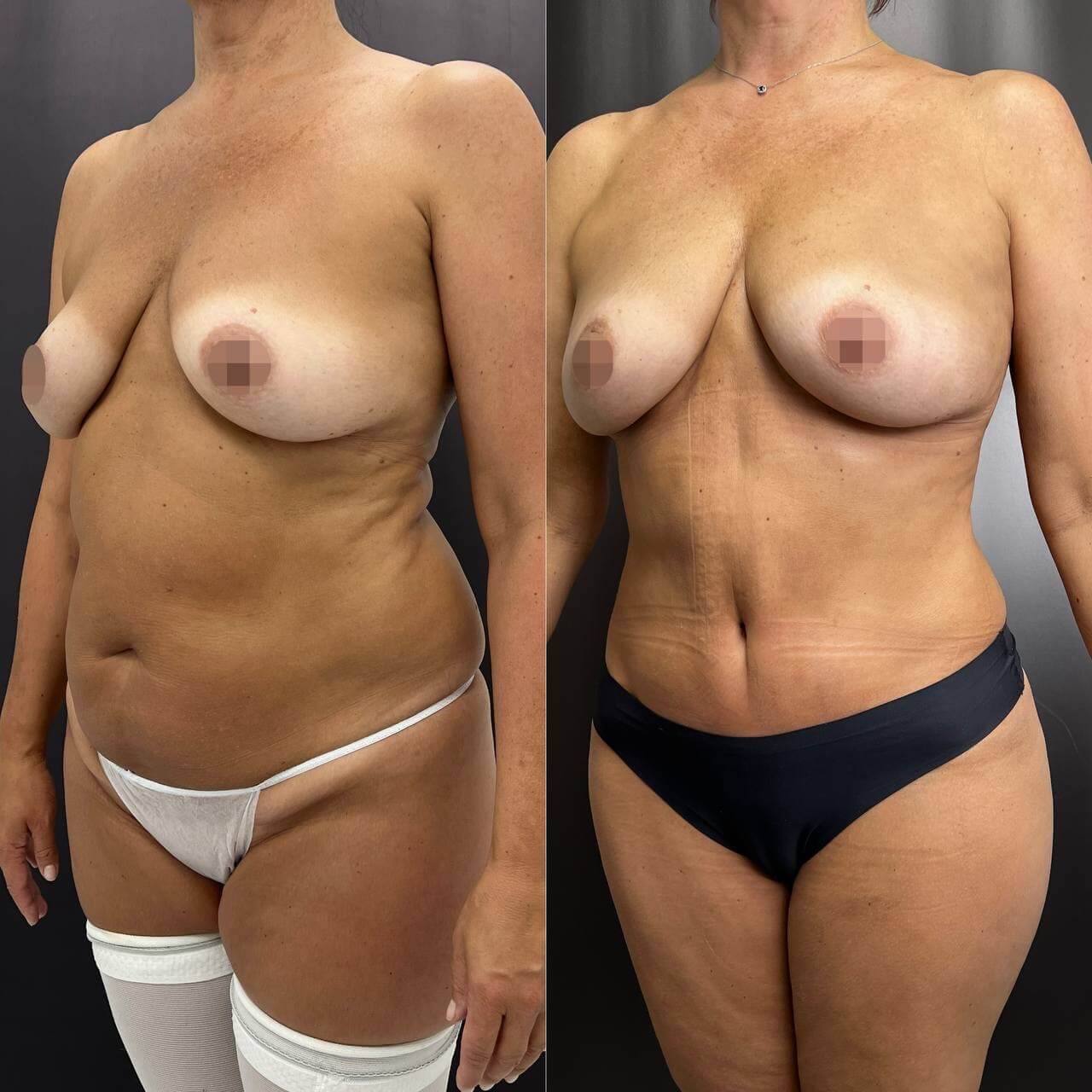 Ушивание диастаза 01