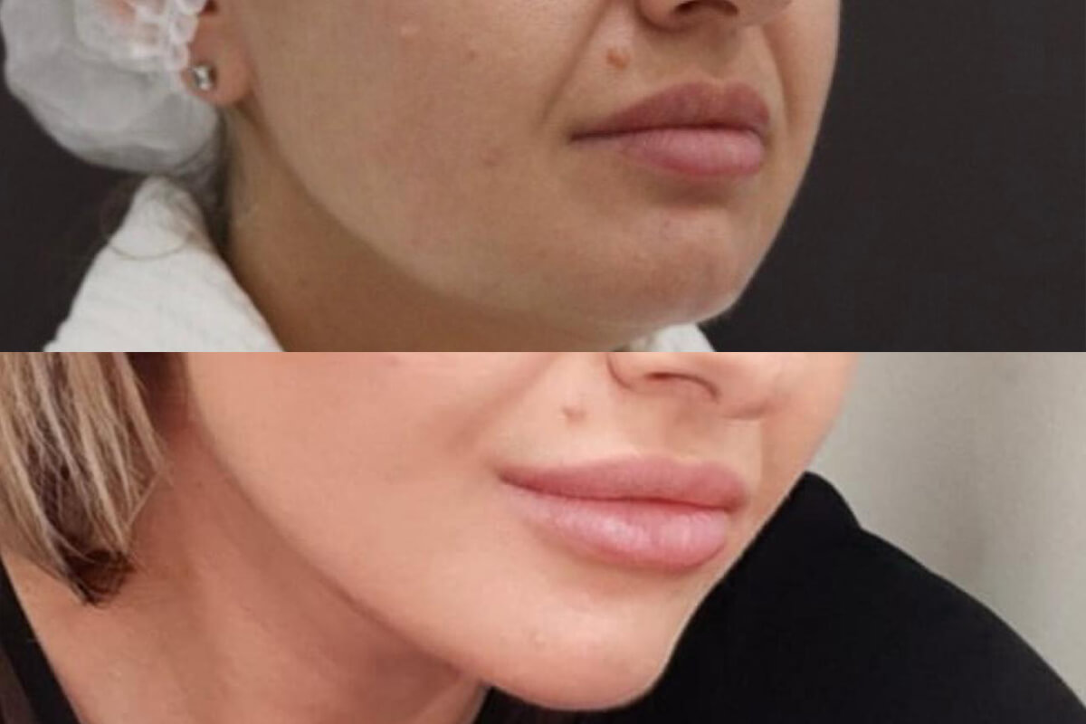 Нитевой лифтинг лица 01