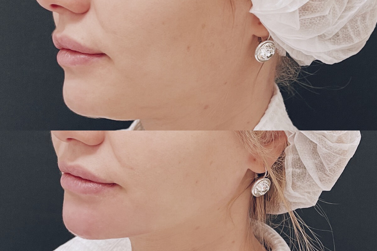 Нитевой лифтинг лица 01