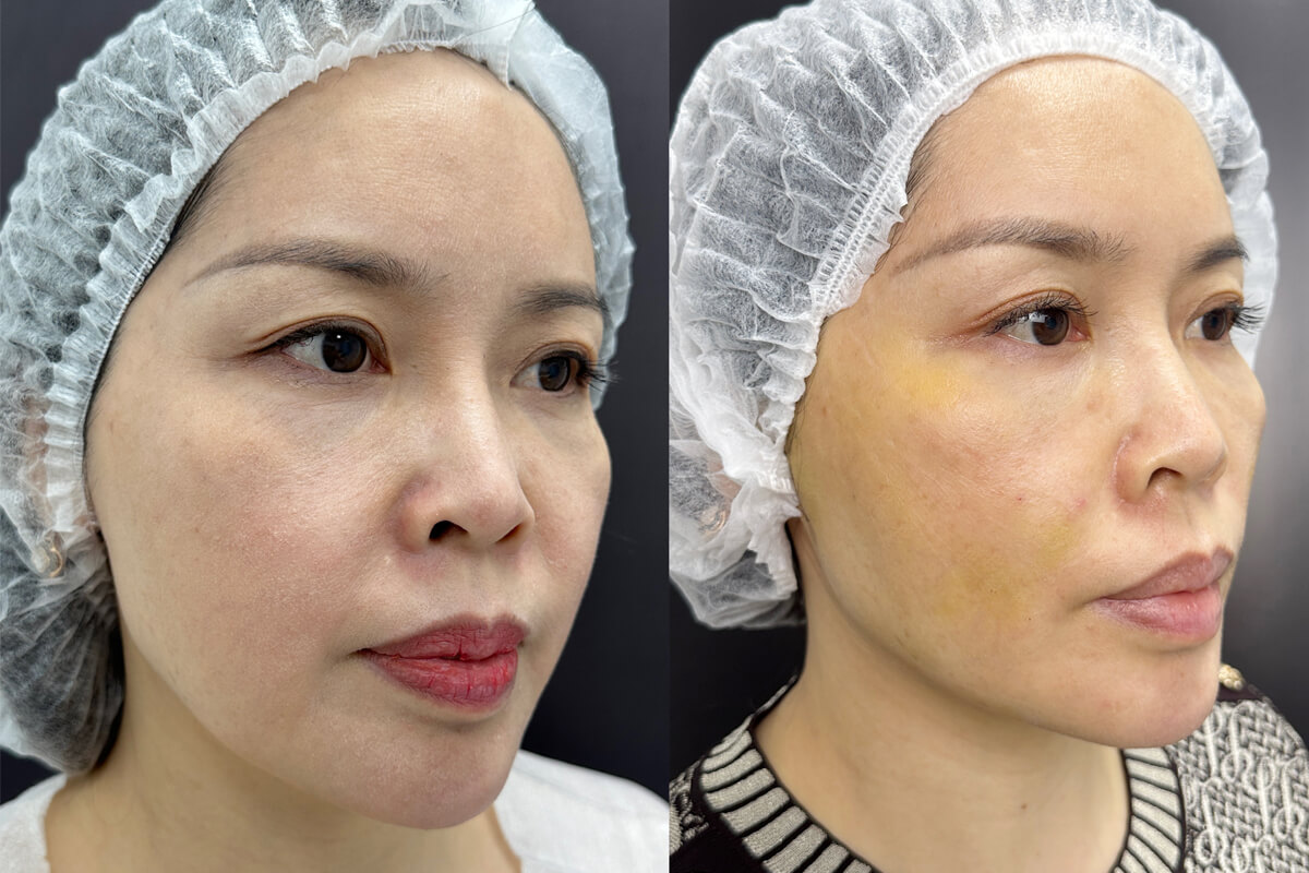 Нитевой лифтинг лица 01