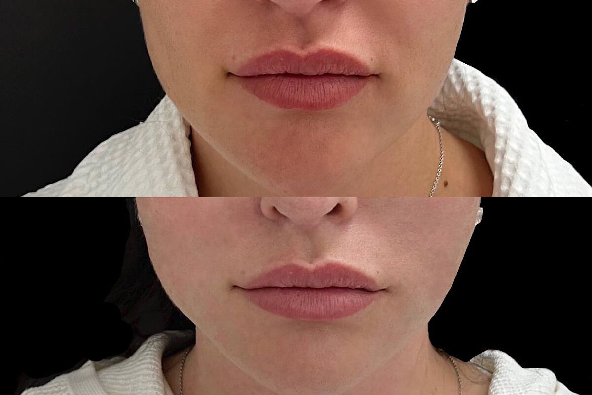 Нитевой лифтинг лица 01