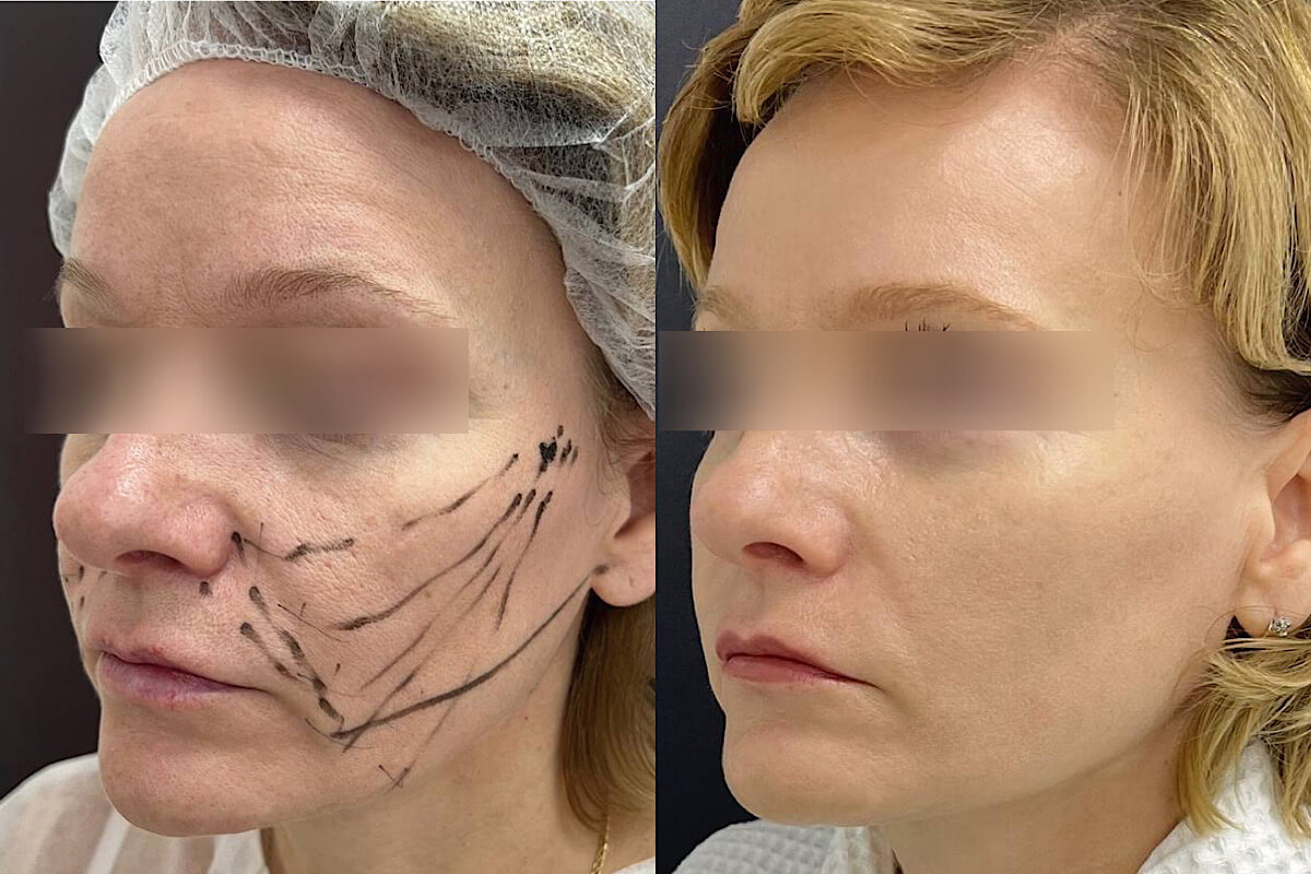 Нитевой лифтинг лица 01