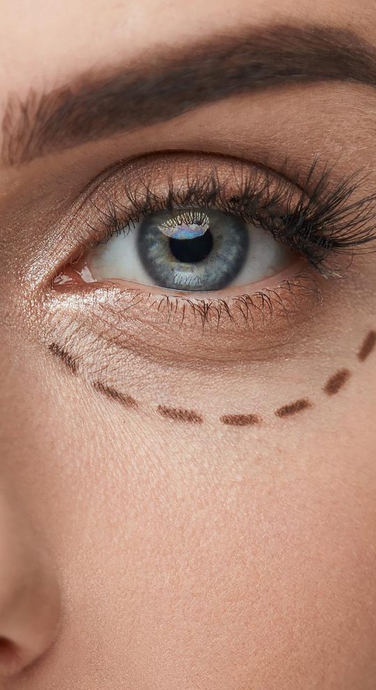 Нижняя блефаропластика