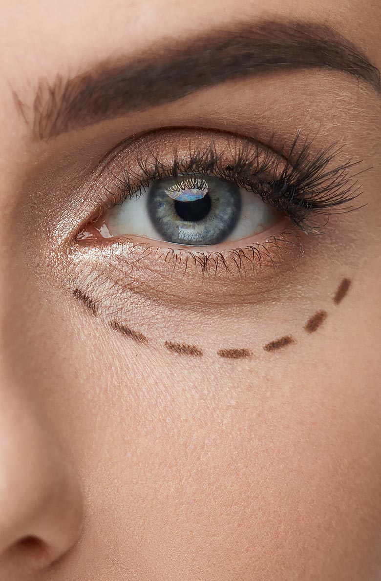 Нижняя блефаропластика