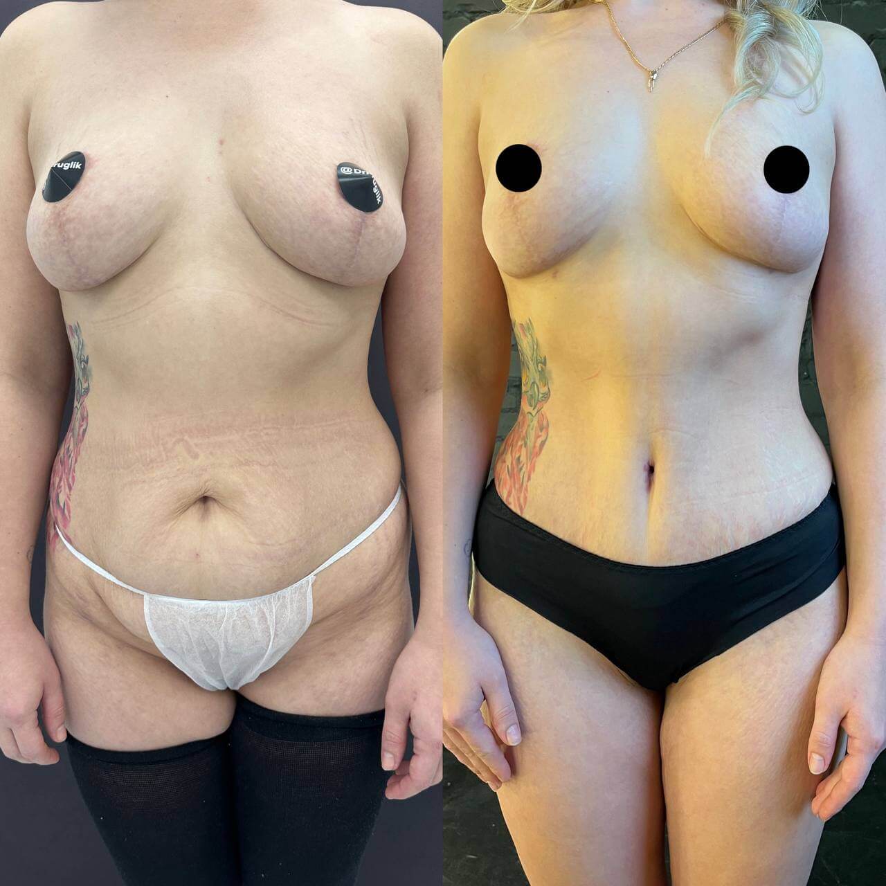 Абдоминопластика с липосакцией 01