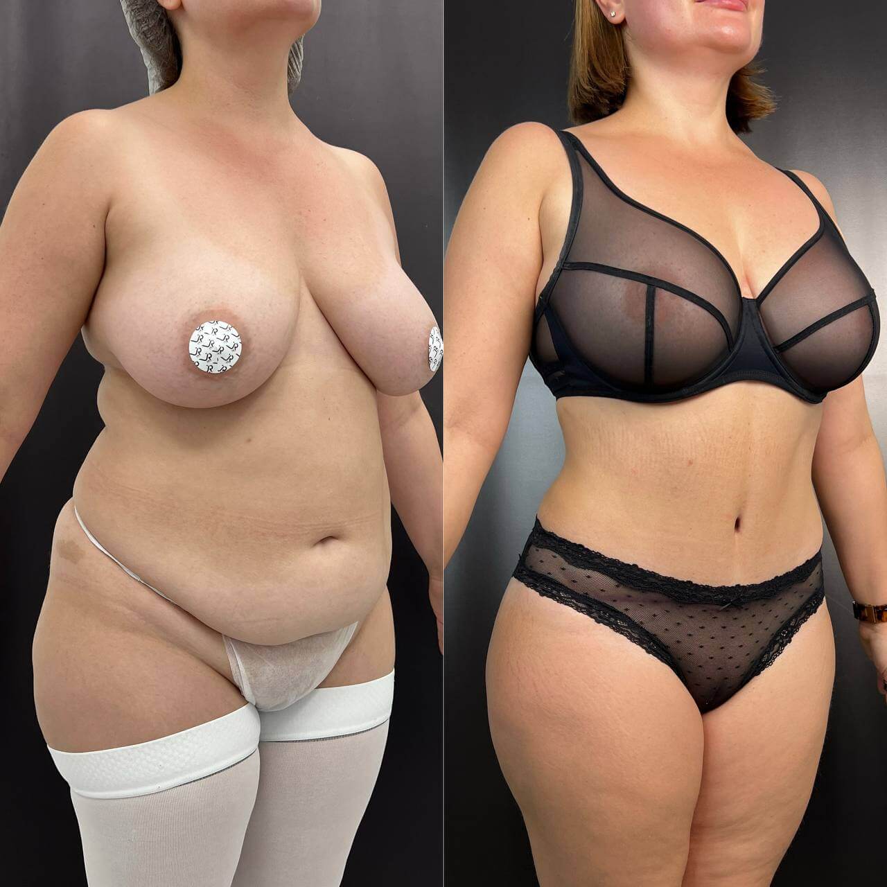 Ушивание диастаза 01