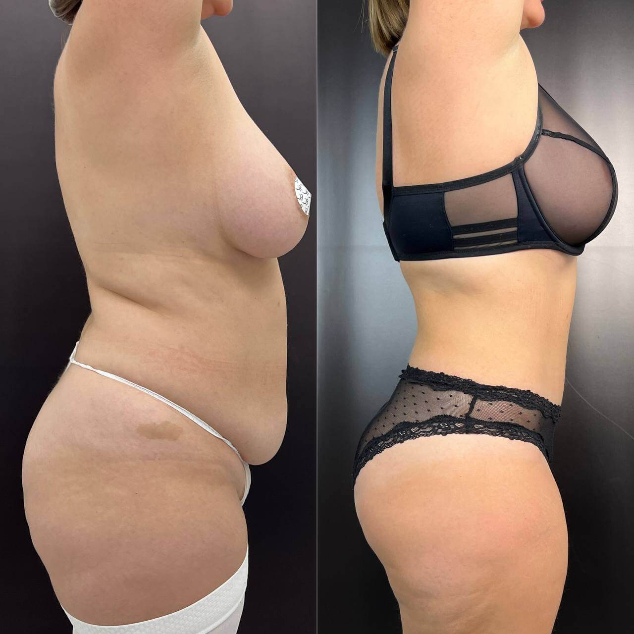 Ушивание диастаза 01