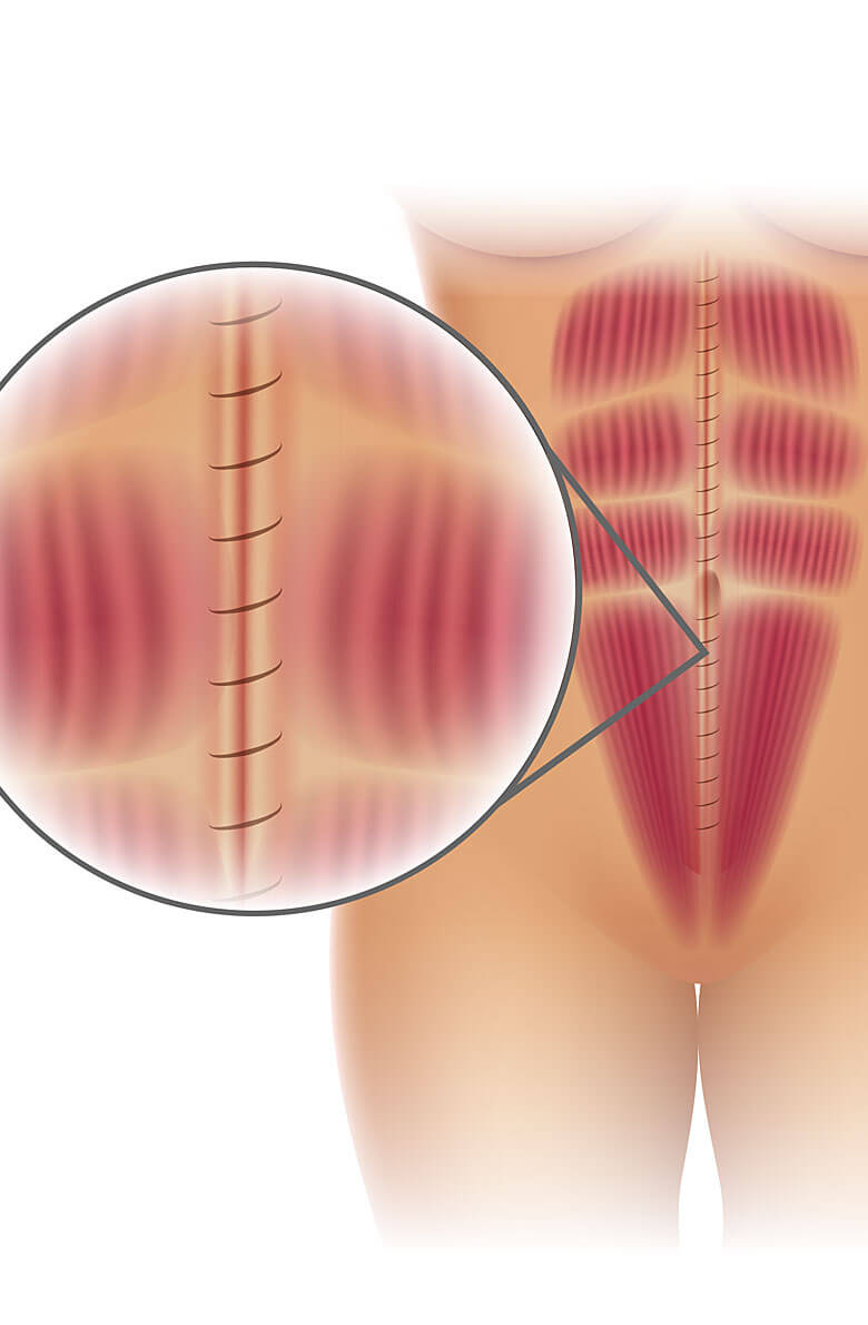 Ушивание диастаза