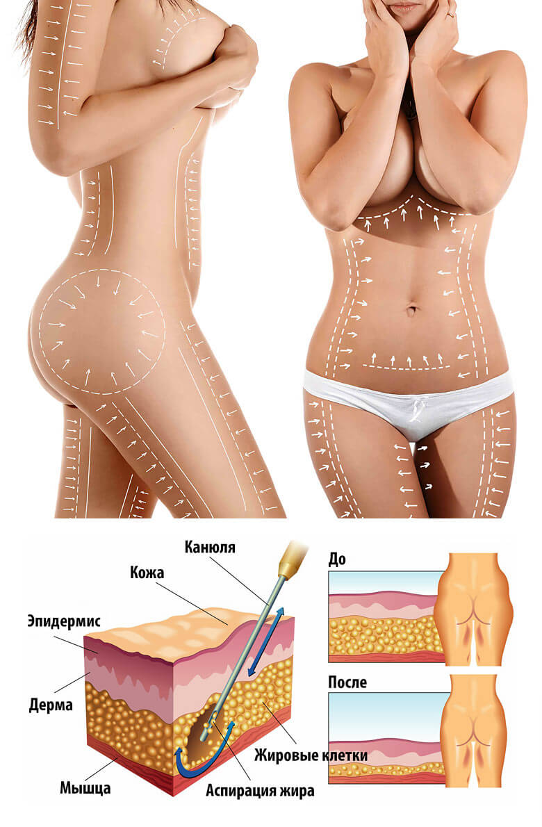 Высокоточная липосакция HD