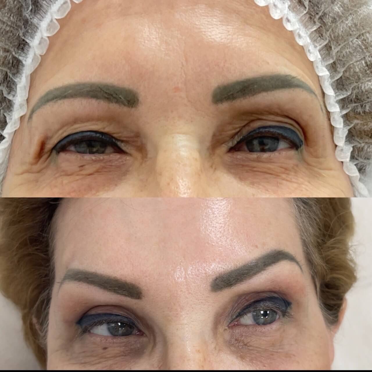 Нижняя блефаропластика 01