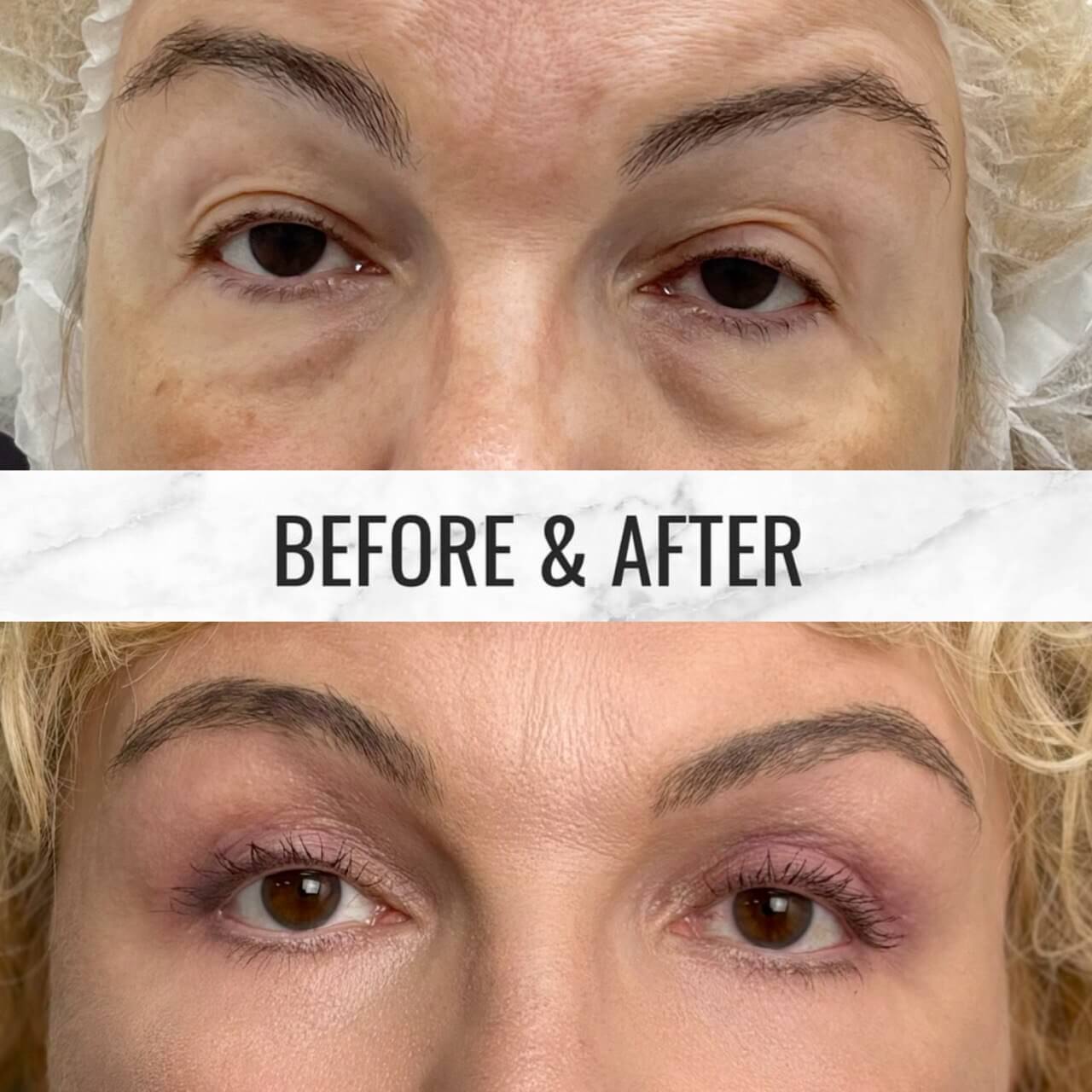 Нижняя блефаропластика 01