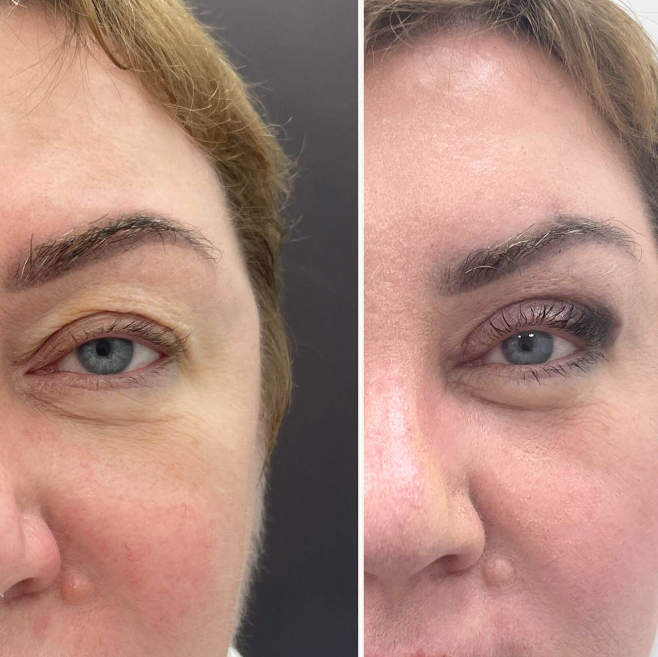 Нижняя блефаропластика 01