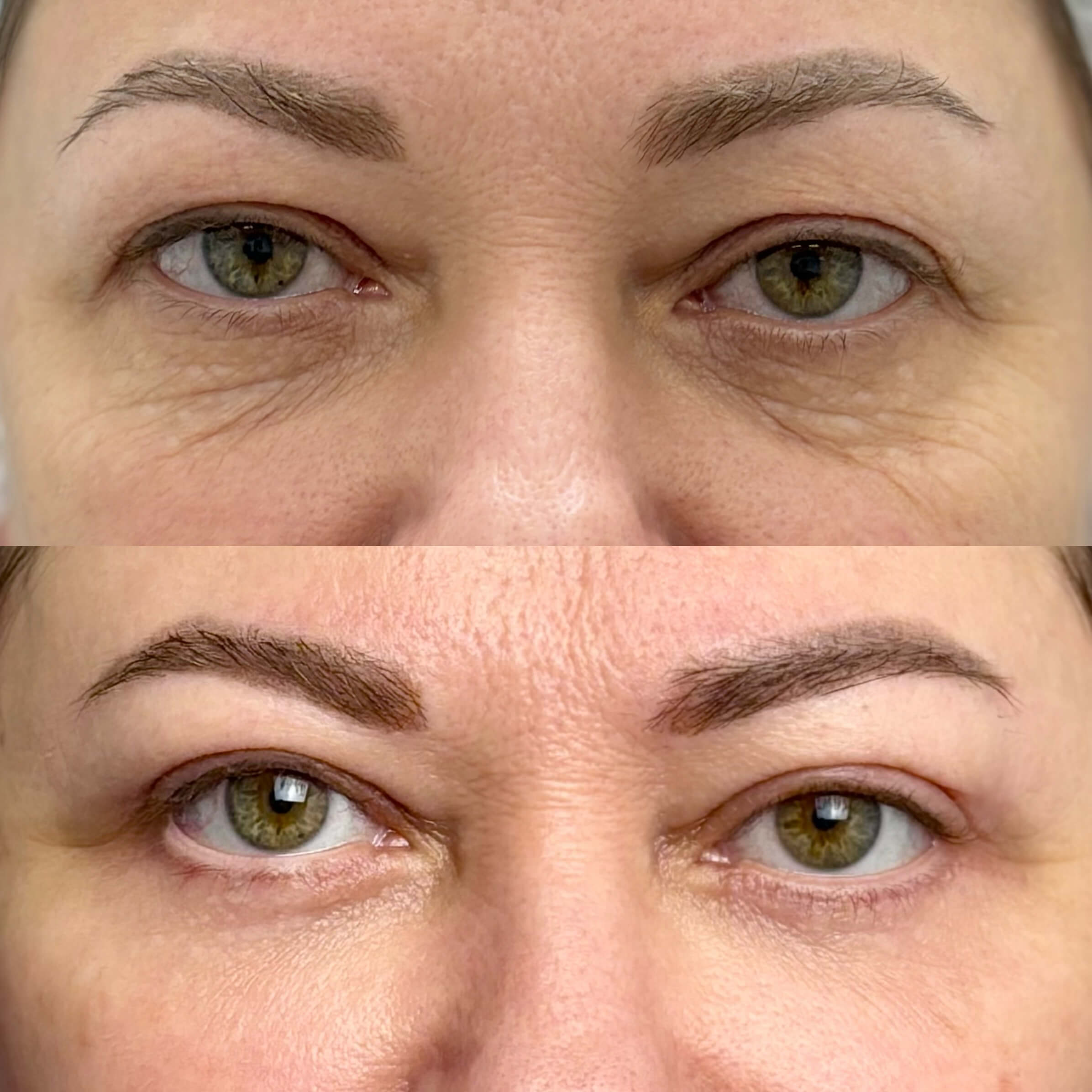 Нижняя блефаропластика 01