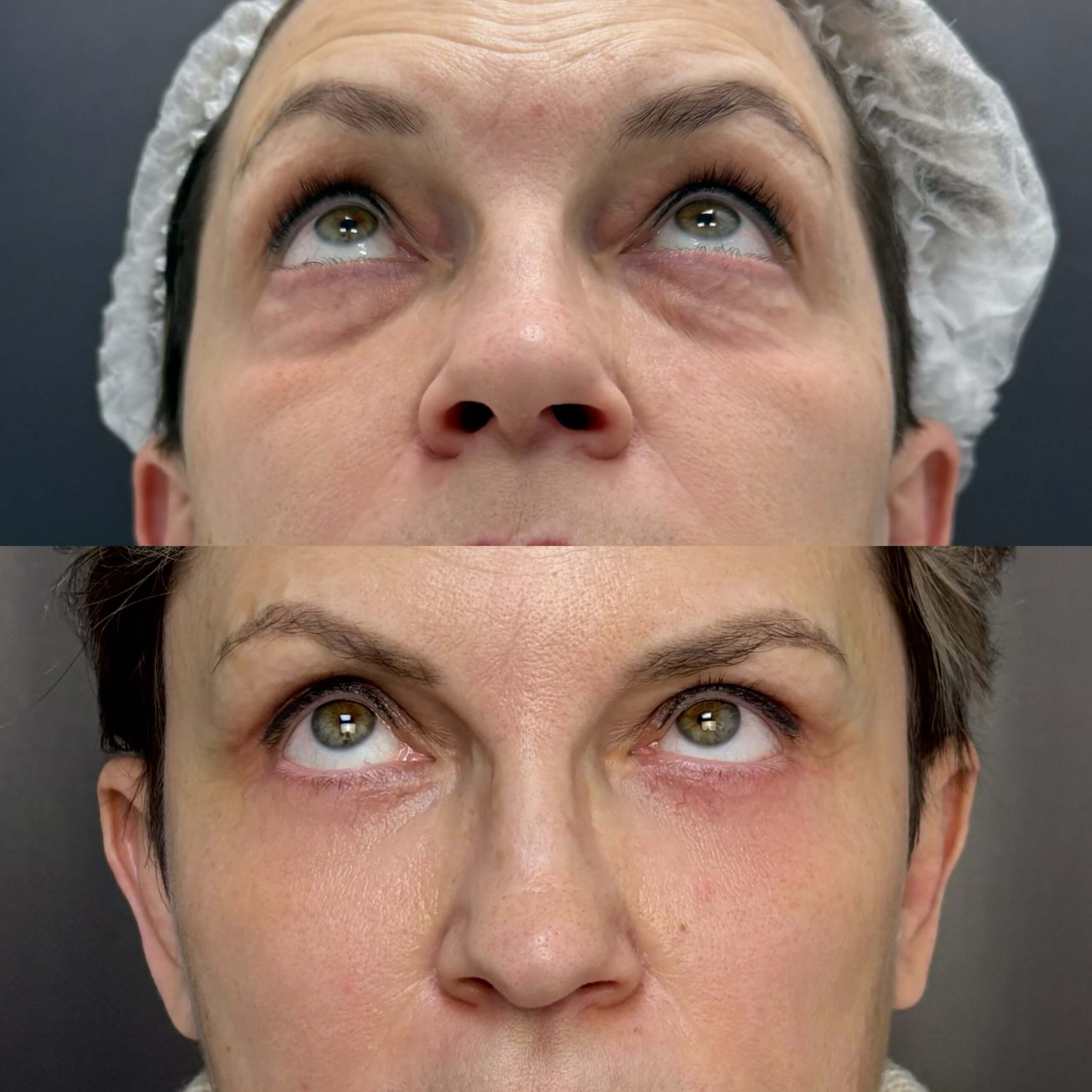 Нижняя блефаропластика 01