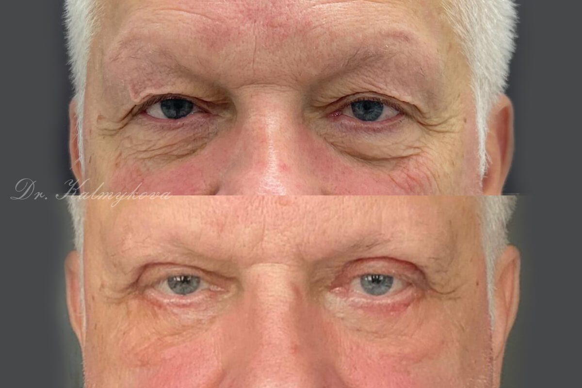 Нижняя блефаропластика 01