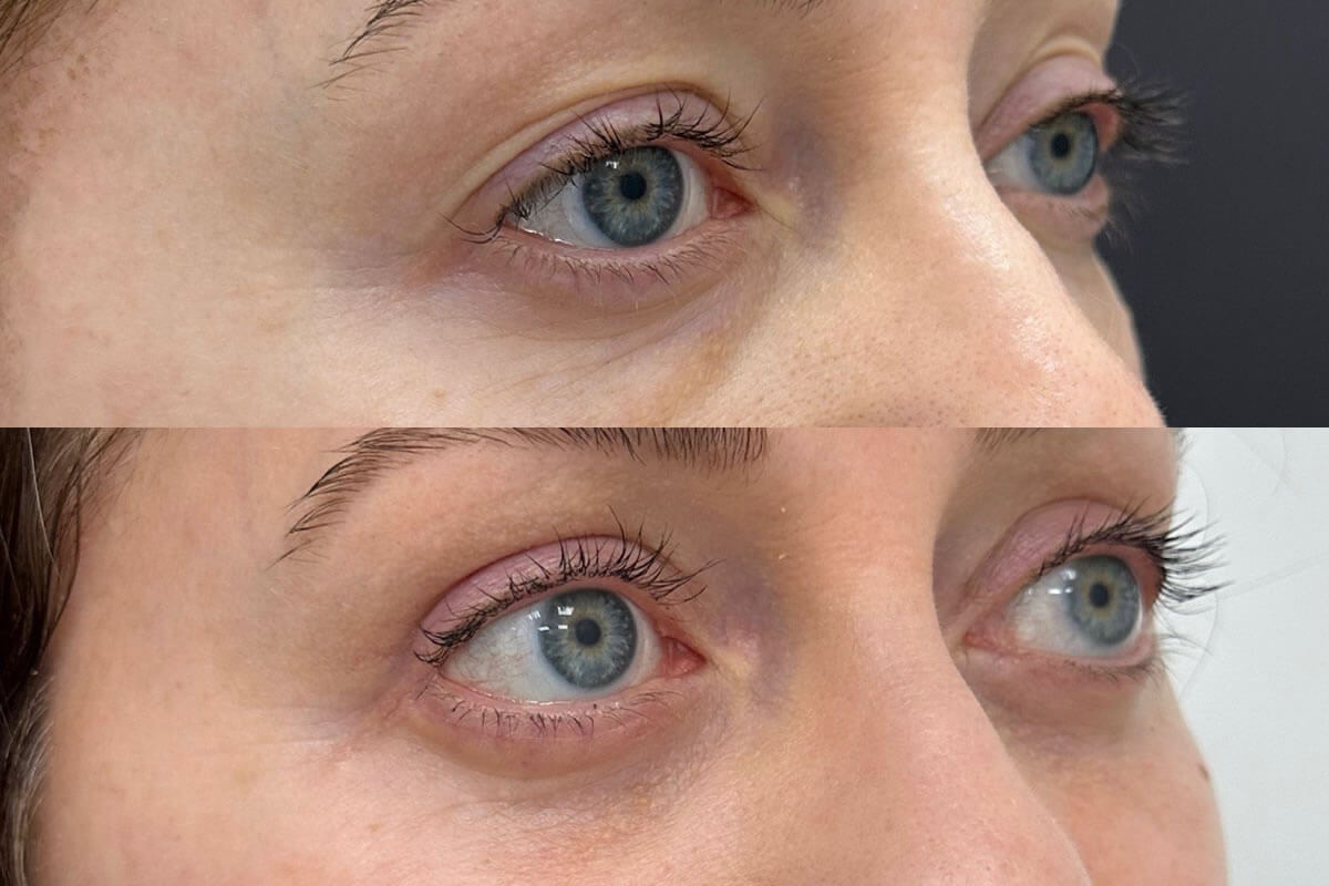 Нижняя блефаропластика 01