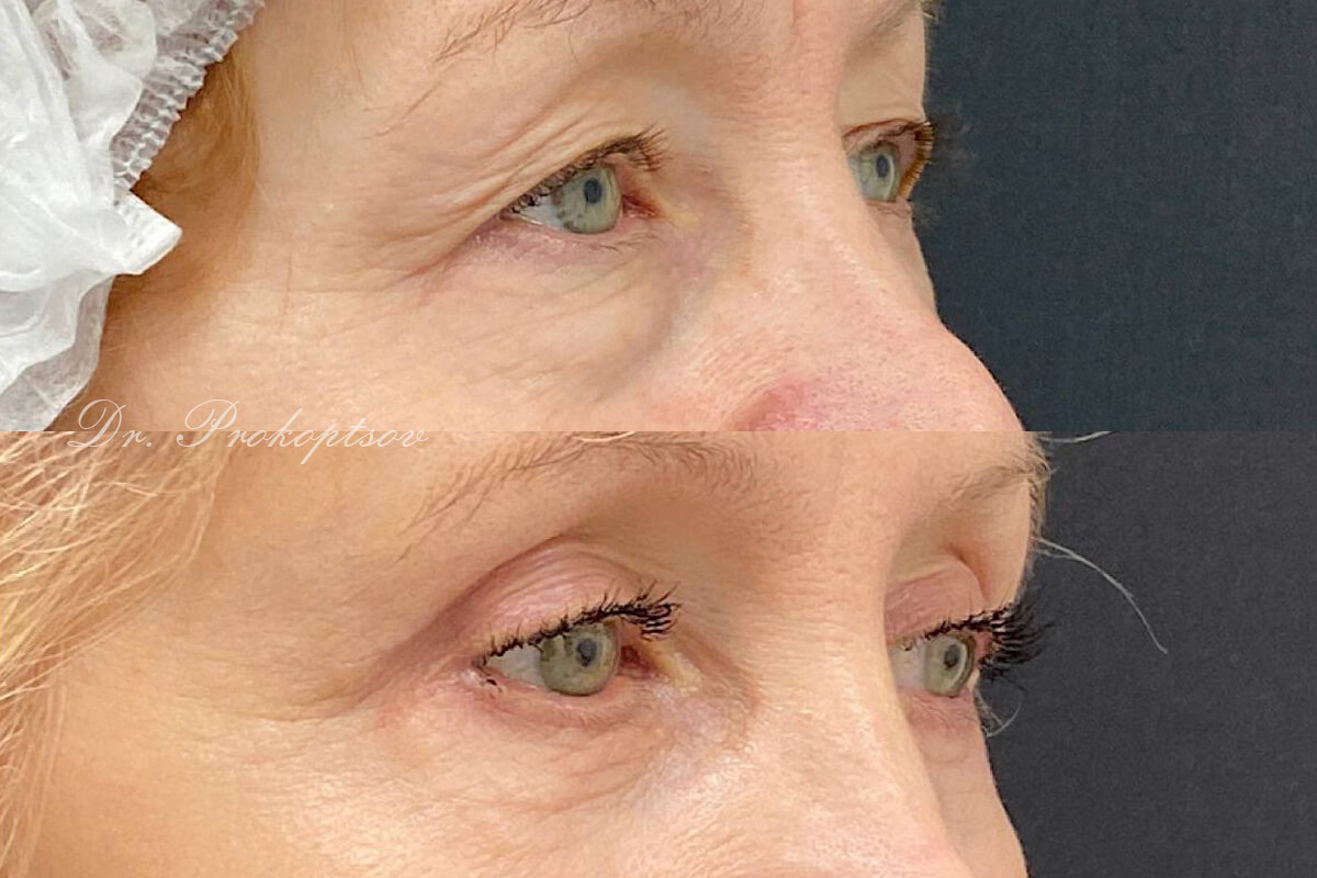 Нижняя блефаропластика 01