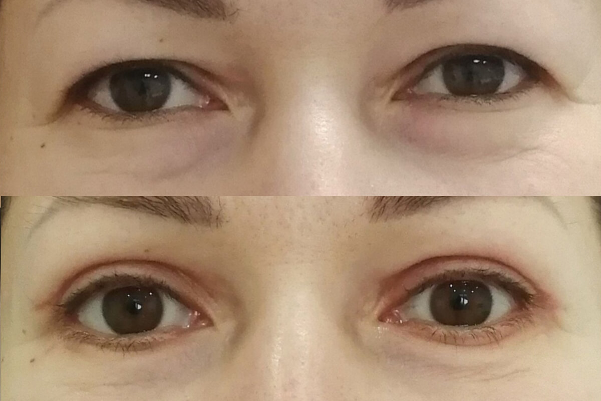 Нижняя блефаропластика 01