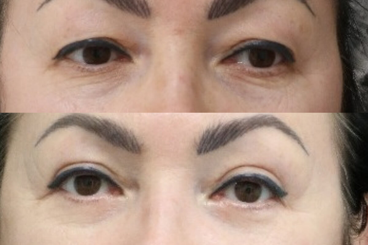 Нижняя блефаропластика 01