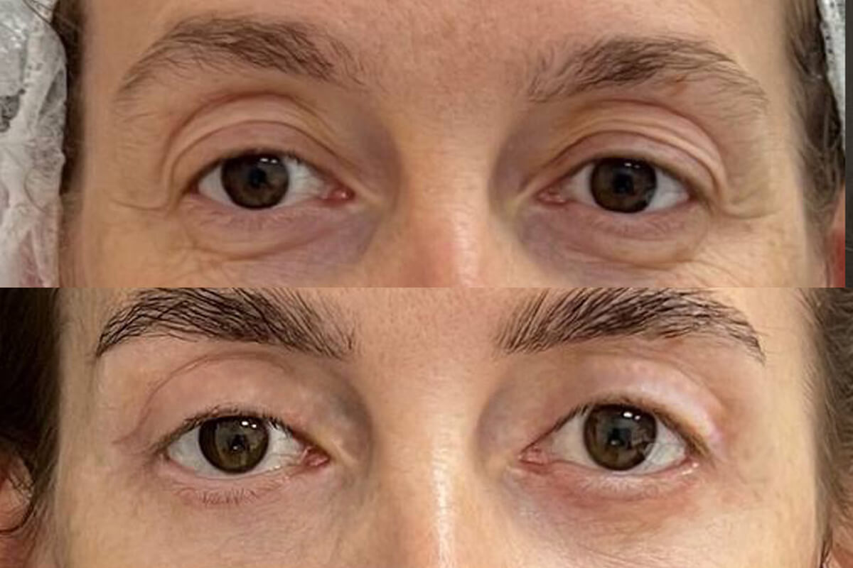 Нижняя блефаропластика 01