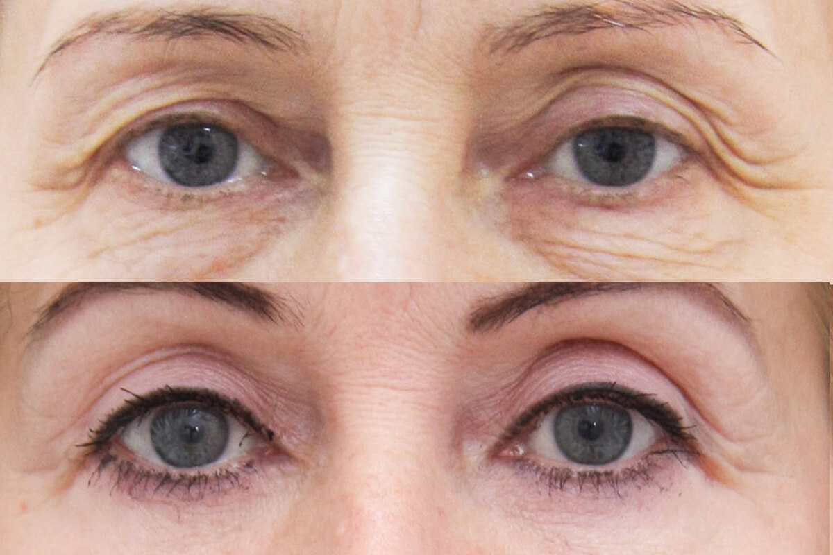 Нижняя блефаропластика 01