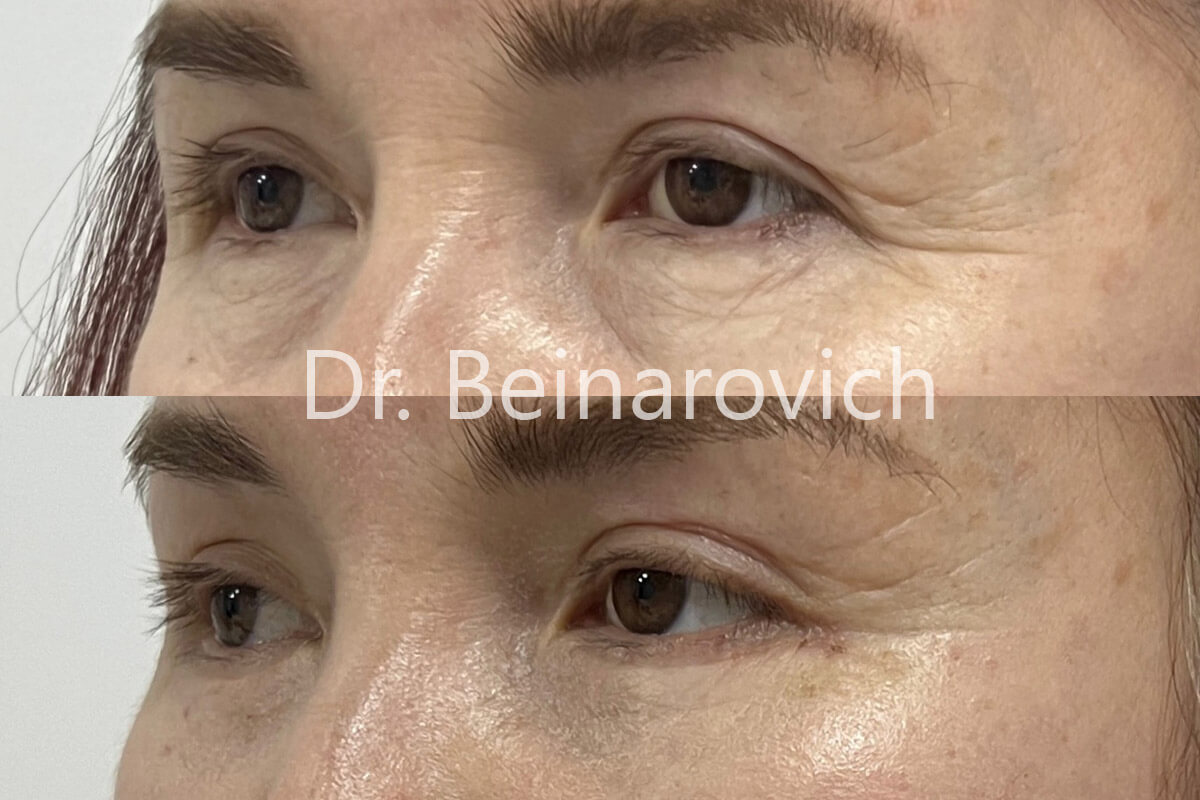 Нижняя блефаропластика 01