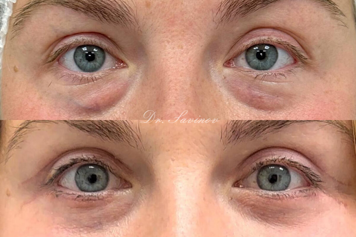 Нижняя блефаропластика 01