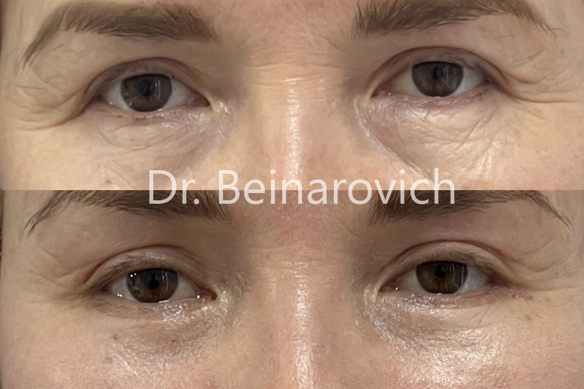 Нижняя блефаропластика 01
