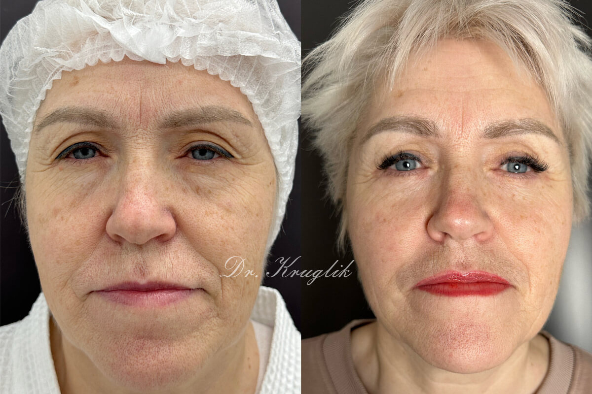 Нижняя блефаропластика 01