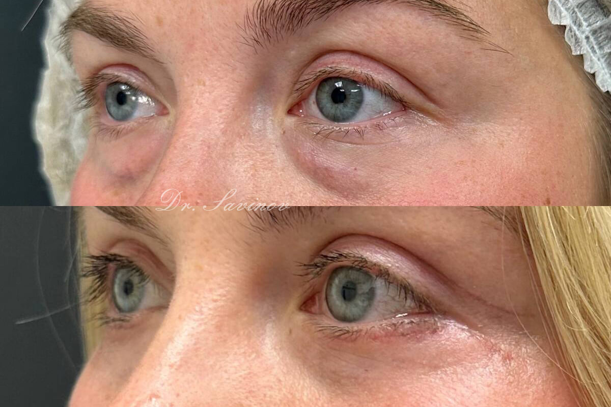 Нижняя блефаропластика 01