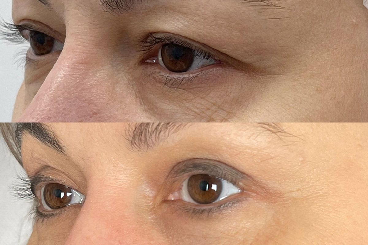 Нижняя блефаропластика 01