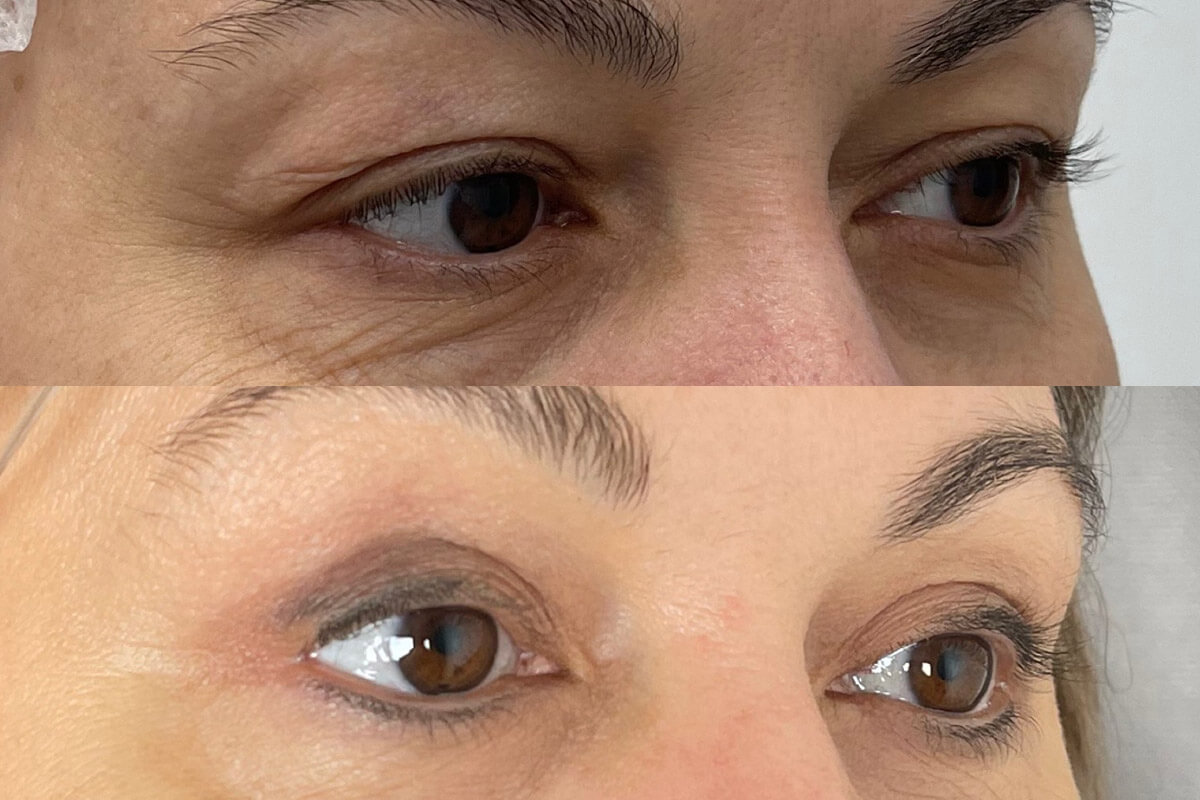 Нижняя блефаропластика 01