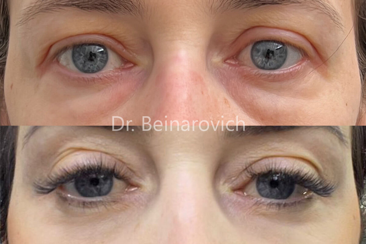 Нижняя блефаропластика 01