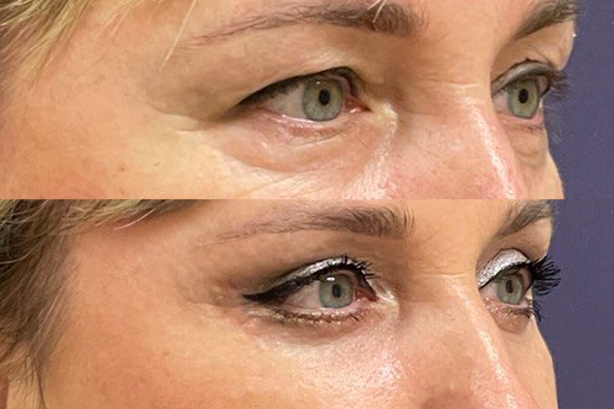 Нижняя блефаропластика 01