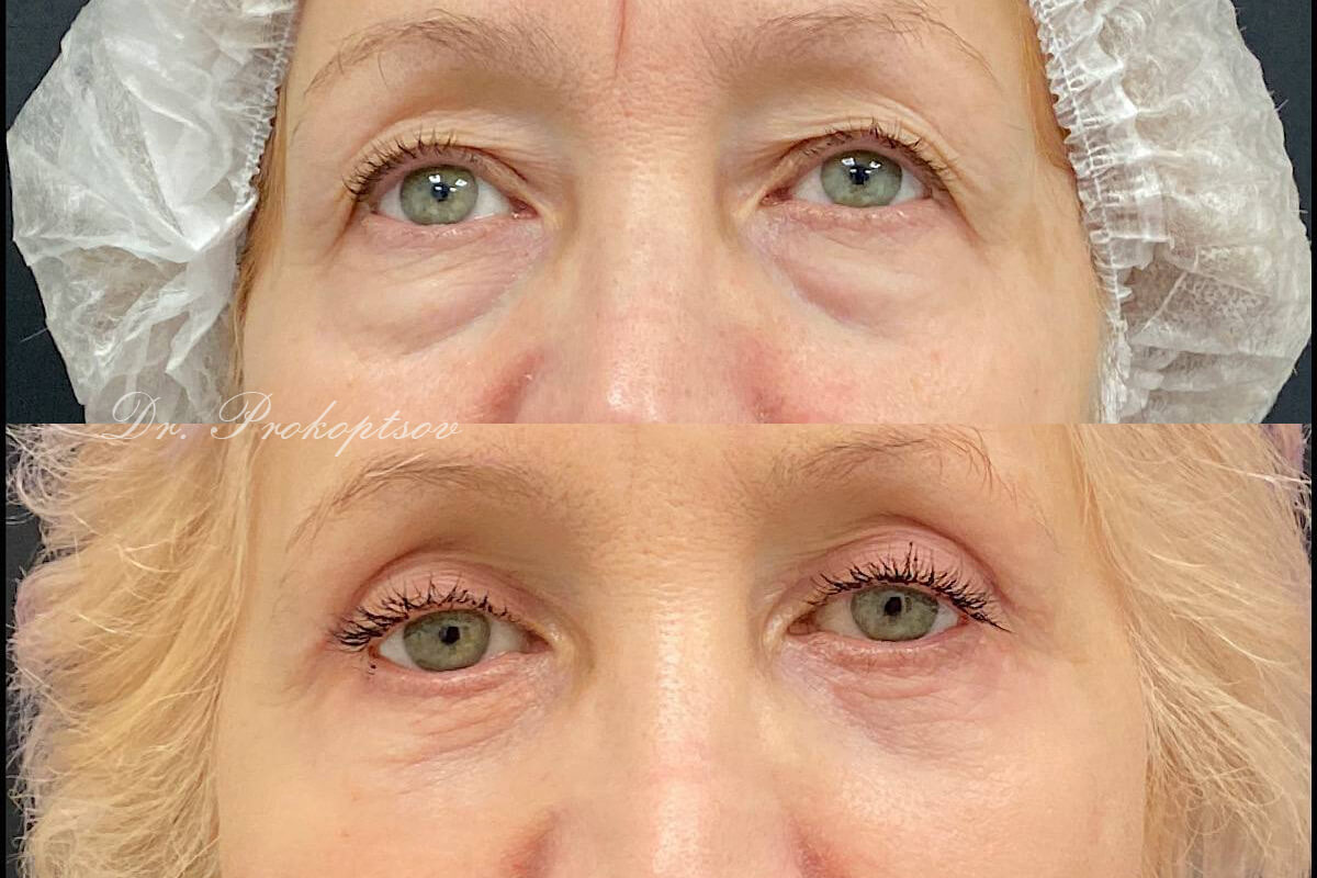 Нижняя блефаропластика 01