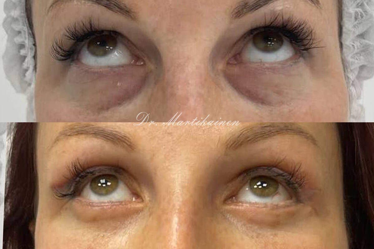 Нижняя блефаропластика 01