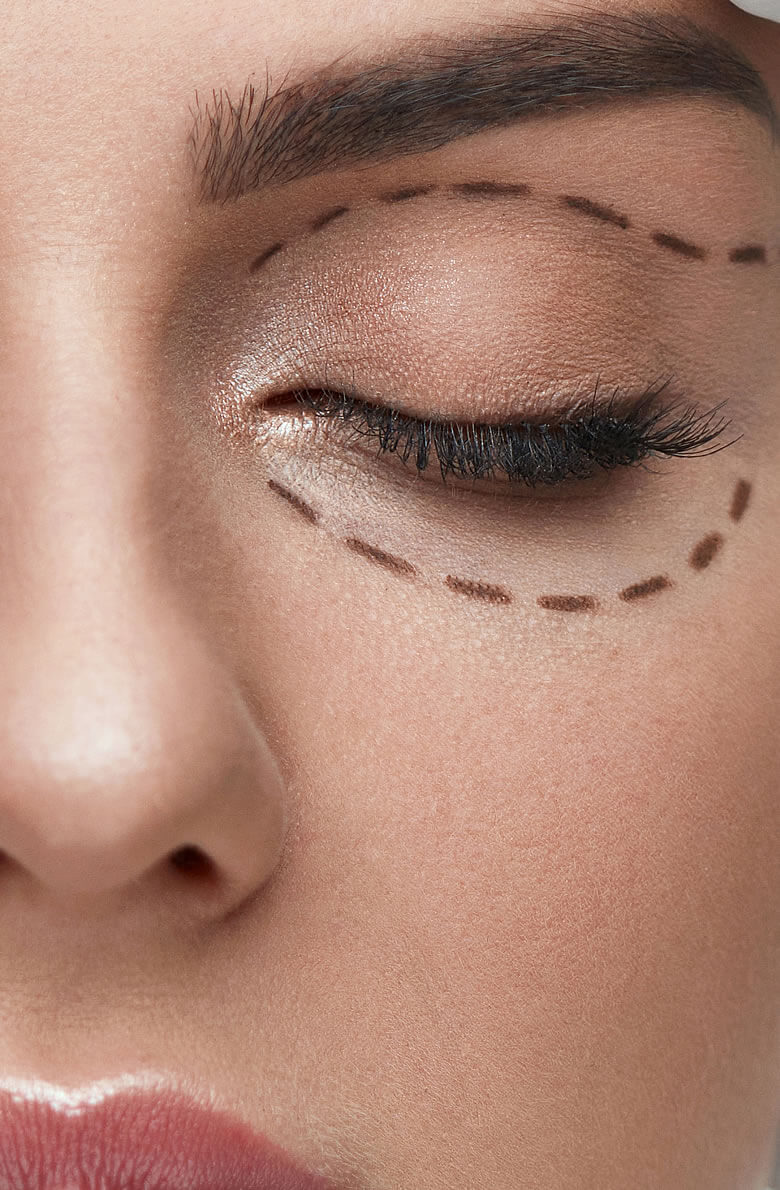 Круговая блефаропластика