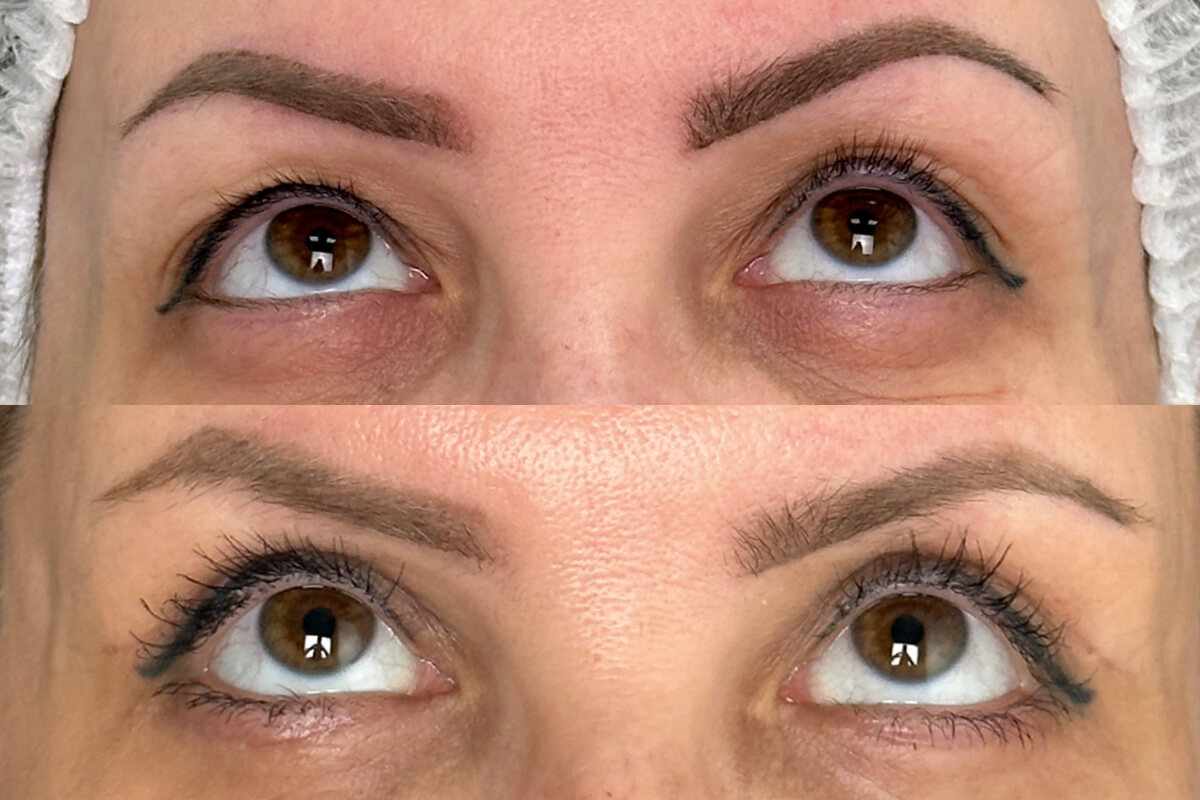 Нижняя блефаропластика 01